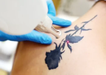 Nada é para sempre: cresce o movimento de remoção de tatuagens