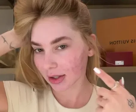 O arrependimento de Virginia após procedimento estético no rosto