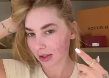 O arrependimento de Virginia após procedimento estético no rosto