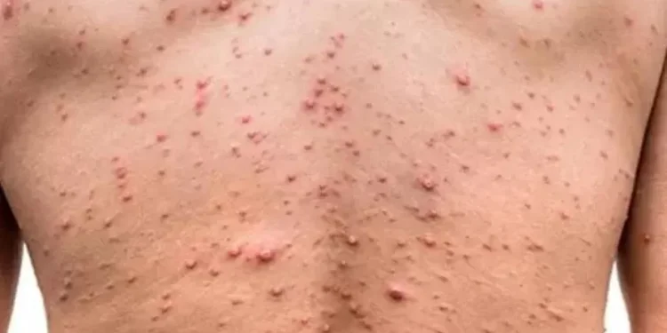 Brasil monitora avanço da mpox com foco em diagnóstico e prevenção